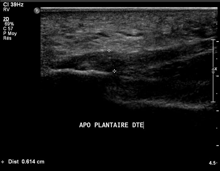 imagerie_pathologie_arriere_pied ANOMALIE EN ZONE D'ENTHESE DE L — free download